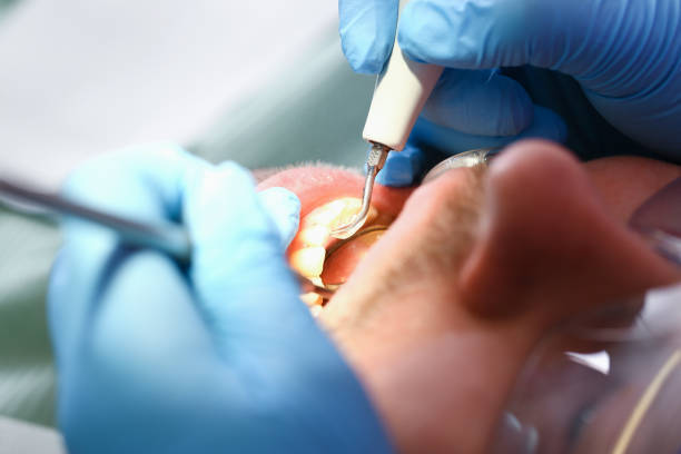 Best Emergency Dental Care for Broken or Chipped Teeth in Jefferson, OH